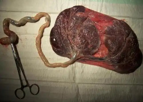 人的胞衣胎盘到底能不能吃呢,真的像老人说的吃了大补吗?