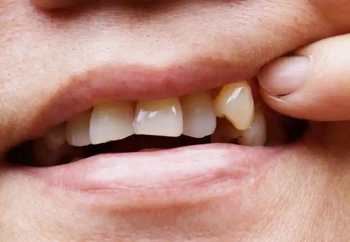 不满几颗尖牙影响微笑?矫正技术助力完美笑容!