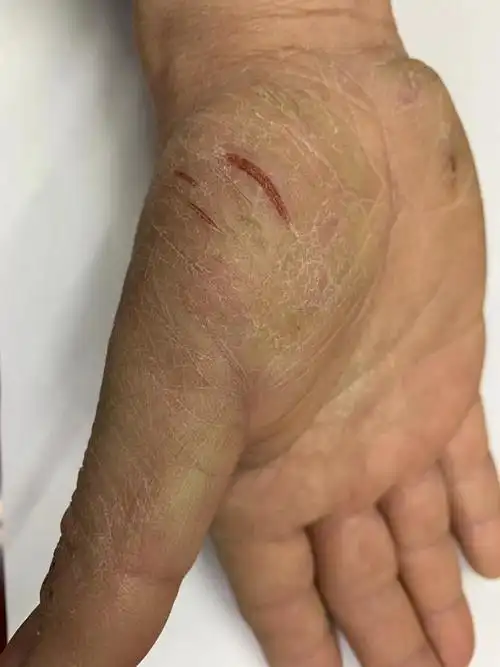 所谓的"鹅掌风"是什么?_癣_介绍_治疗方式_日常注意事项 - 好大夫在线