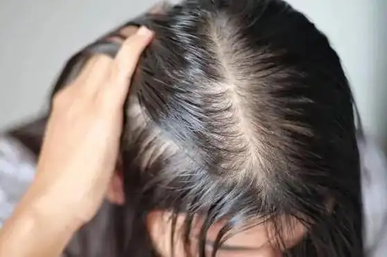 头发爱出油还脱发怎么办?提醒:跟着照做,或有助于控油养发固发