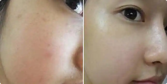 补水保湿-水光补水效果图,案例前后对比照片