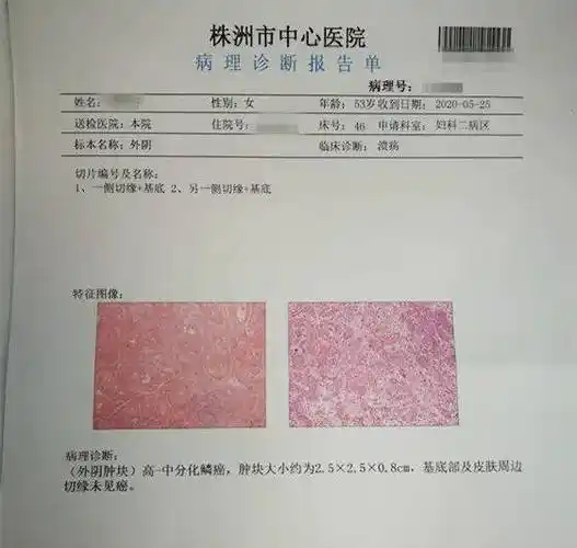 谭女士外阴癌养成记