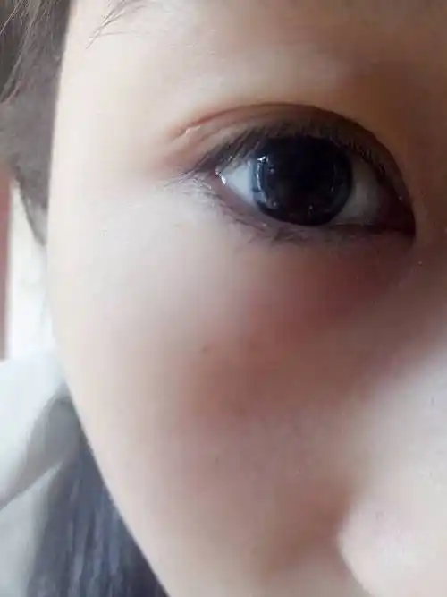 个东西,不知道是什么,怎么去掉里面不是脓包,是肉肉的,就是一个小疙瘩