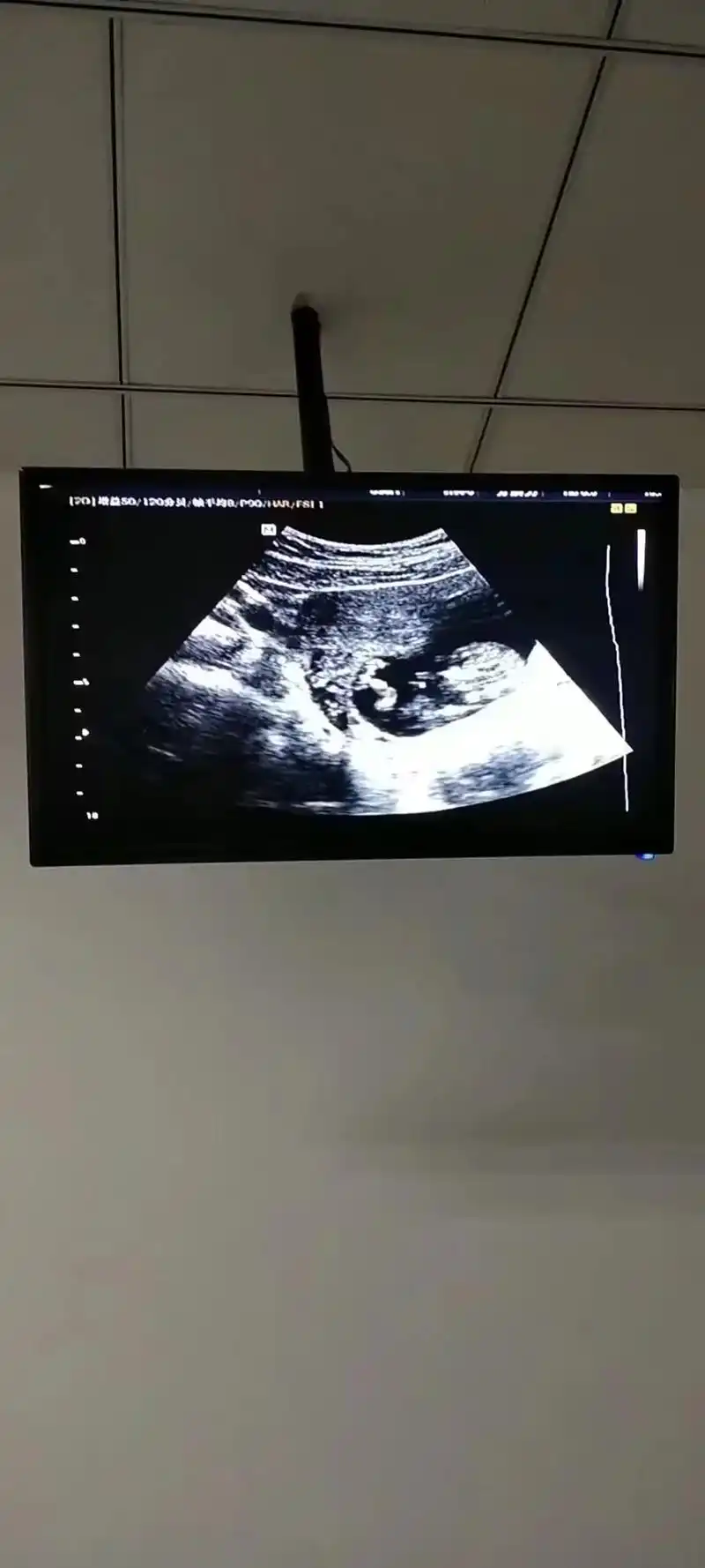 胎盘早剥剖腹产.预产期8.14 #剖腹产#愿我的宝贝健康快乐 - 抖音