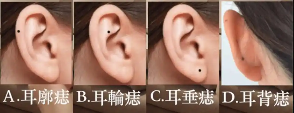 耳中有痣的人是个能够听从别人的建议,能够判断出哪些是对自己好的