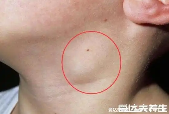 淋巴结肿瘤早期症状,典型症状无痛性淋巴结肿大图片(脖子和腋下图)