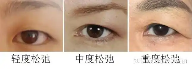 一,上眼睑松弛程度