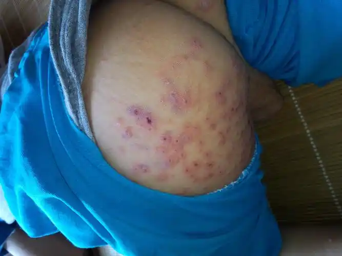 我家一岁半宝宝身上长满红色有浓点包包