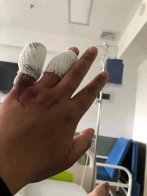 网友乘嘀嗒顺风车被司机拿刀砍伤 面临截肢危险