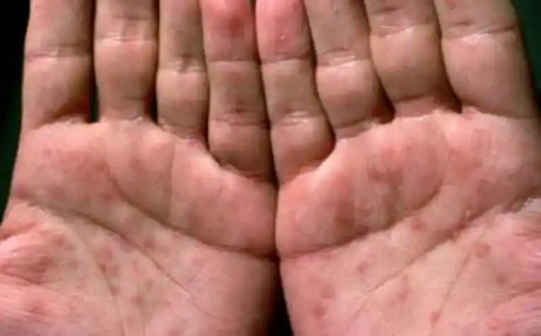 男性刚得了梅毒的照片( 男性刚得了梅毒的照片什么药治梅毒 )