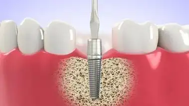 种植牙真的可以一劳永逸吗?