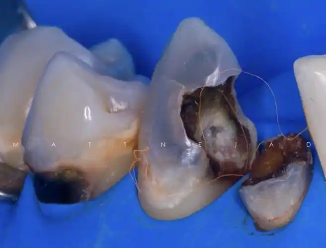 最烂的牙齿坏牙龋齿图片图片下载图片id873772人体器官图片素材聚图2