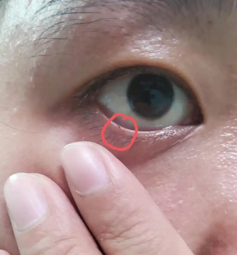 下眼睑长了痣(第五张图慎点) 请忽略我的烂皮肤 去年有一天照镜子