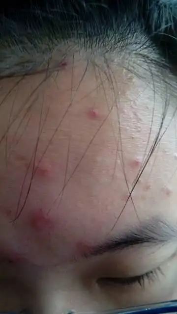 问一下,这是青春痘还是痤疮?该怎么消除或改善?