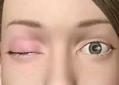 赞叹|换血!成功救治"难治性重症肌无力"小伙儿