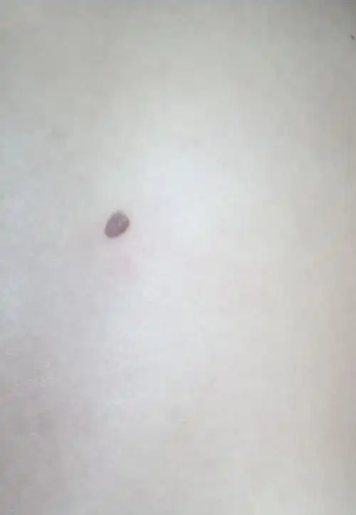 后背上长了一颗大黑痣,小时候没有,不疼不痒,最近发现变大了,软软的