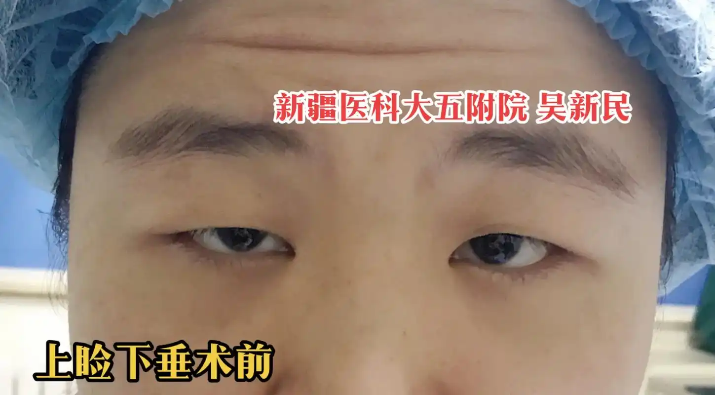 上睑提肌无力 上睑下垂#相信专业决心美丽 #新疆乌鲁木齐  - 抖音