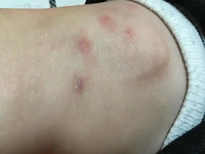 跳蚤咬伤的治疗怎么处理好些