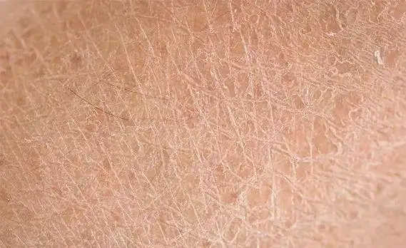 天气转凉 皮肤干燥起鳞屑 是鱼鳞病吗?