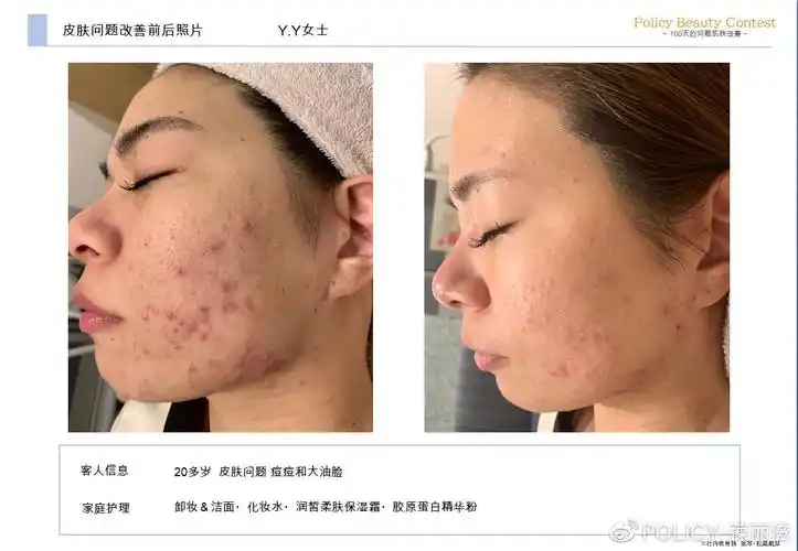 改善前/改善后67※老师讲解皮肤皮脂分泌过多,缺水,就会出现外油内