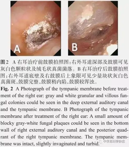 103例外耳道真菌病的诊疗分析
