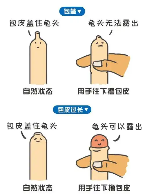 几乎每个男宝生下来都是包茎,随着孩子发育,大部分的包茎都会好转.