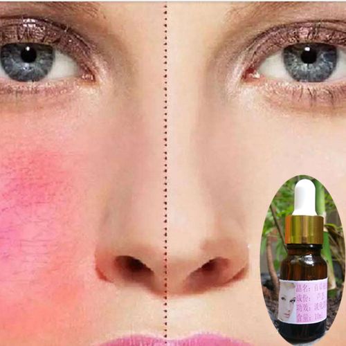 红血丝修复精油 补水敏感肌肤专用脸皮肤精华液收缩毛孔