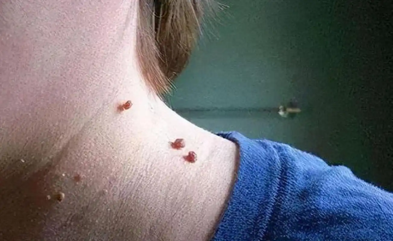 被确诊了扁平疣!