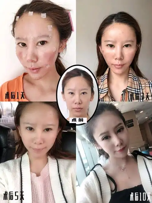 为什么全脸填充医生建议自体脂肪填充而不是玻尿酸?