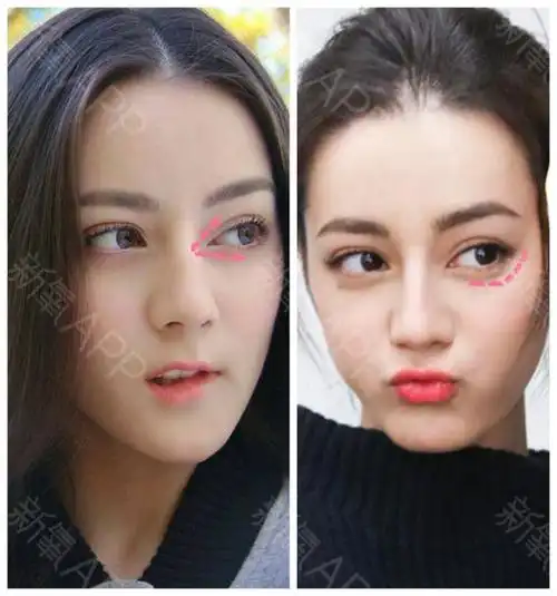 热巴的内外眼角和下眼睑,就是典型的芭比眼_圈子-新氧美容整形