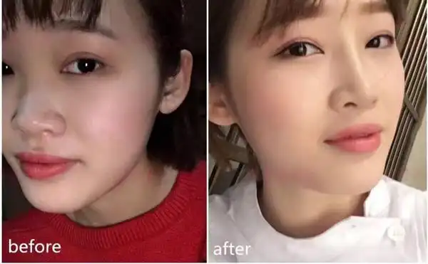 玻尿酸隆鼻效果对比