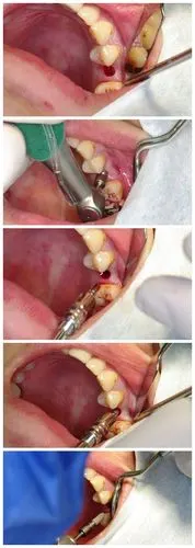 种植牙步骤先介绍下本人,张永刚:口腔主治医师,同济大学口腔医学硕士