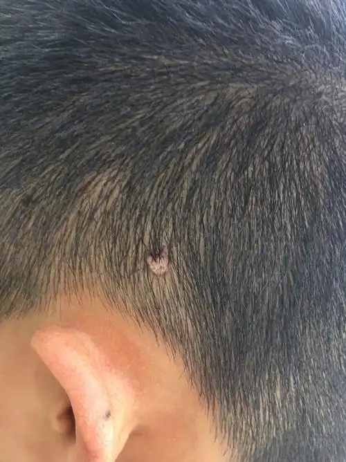 老公头上长了一个这个有宝妈知道这是什么吗