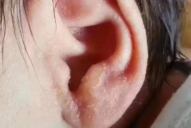 耳廓癣
