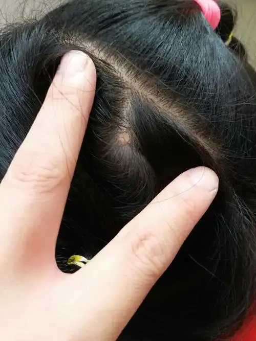 小孩八岁,头皮上长了个像层皮的东西,三四年了,不疼不痒,感觉变小了点
