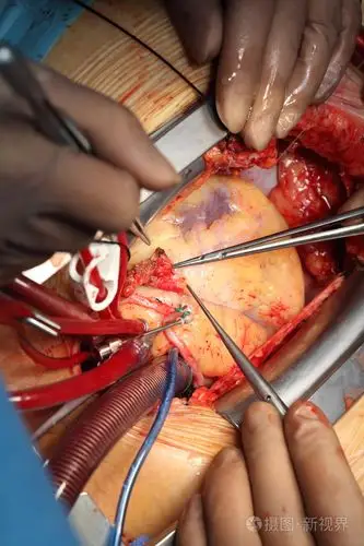 心脏外科手术照片-正版商用图片1enxn7-摄图新视界