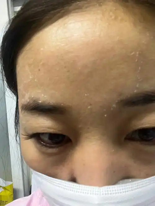 最近的我呀 ～～～对消毒水 皮肤过敏 眼睛过敏  最丑的样子 - 抖音