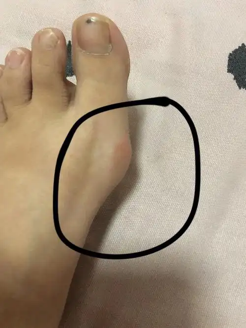 大脚骨真的影响减肥