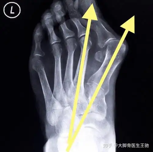 关于大脚骨的危害与解决方式