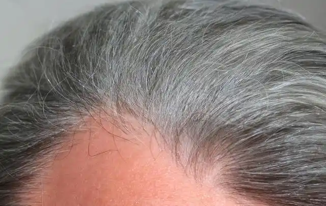 青少年白发遗传因素居多.