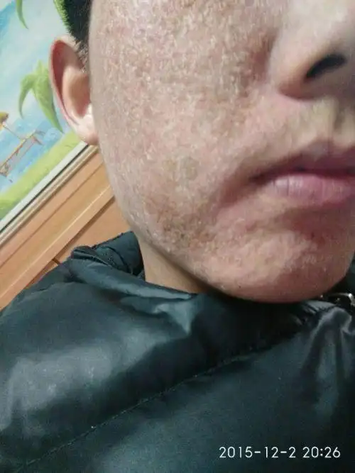 脸上皮肤开裂脱皮