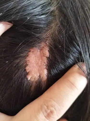 有更好的答案 1条回答  首先,给你提个意见,注意个人卫生,你有头皮屑