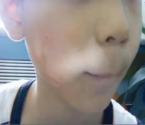 儿童白斑初期症状图片7