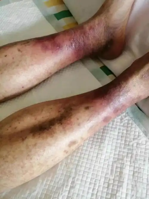 长时间久站腿部红肿皮肤烂了