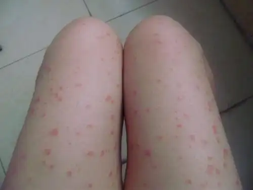 各种癣的症状图片及名称_银屑病求医网