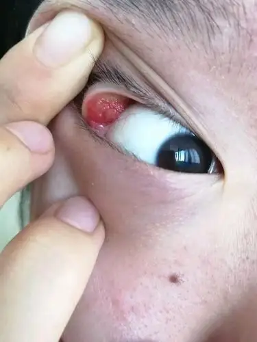 霰粒肿 正文不想修行: 回复 mhwmhz :谢谢楼主 医生说是麦粒肿引起的