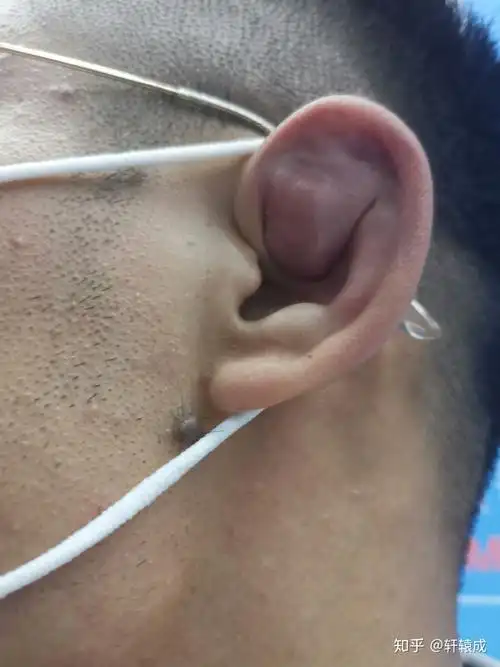 耳朵轮廓上长一个大的浓包