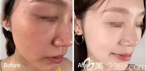 干燥油腻与水嫩白皙皮肤的对比