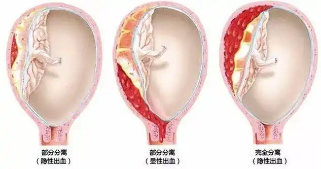 解析:产科医生最害怕的「胎盘早剥」