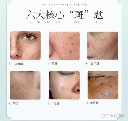 清肌叶,回归肌肤美丽本初 我发现每到秋冬,雀斑妆就会相当火,不仅仅是